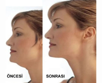 Gıdı Toparlama Boyun Gıdı Masaj Aleti